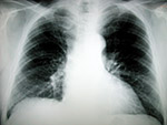 lungs xray